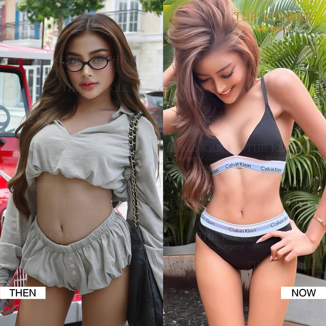 Liposuction-Review-Getting-NewBody-NestySpicy