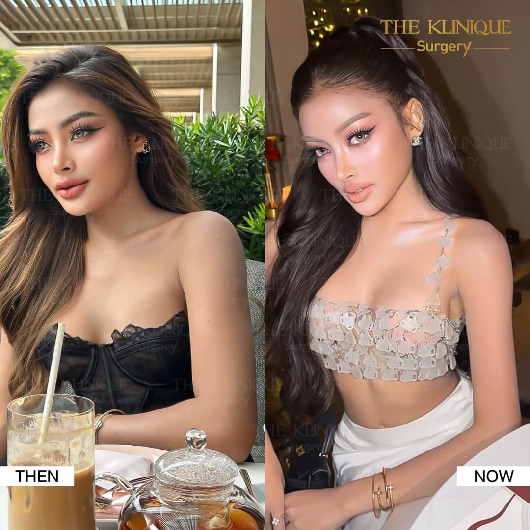 Liposuction-Review-Getting-NewBody-NestySpicy