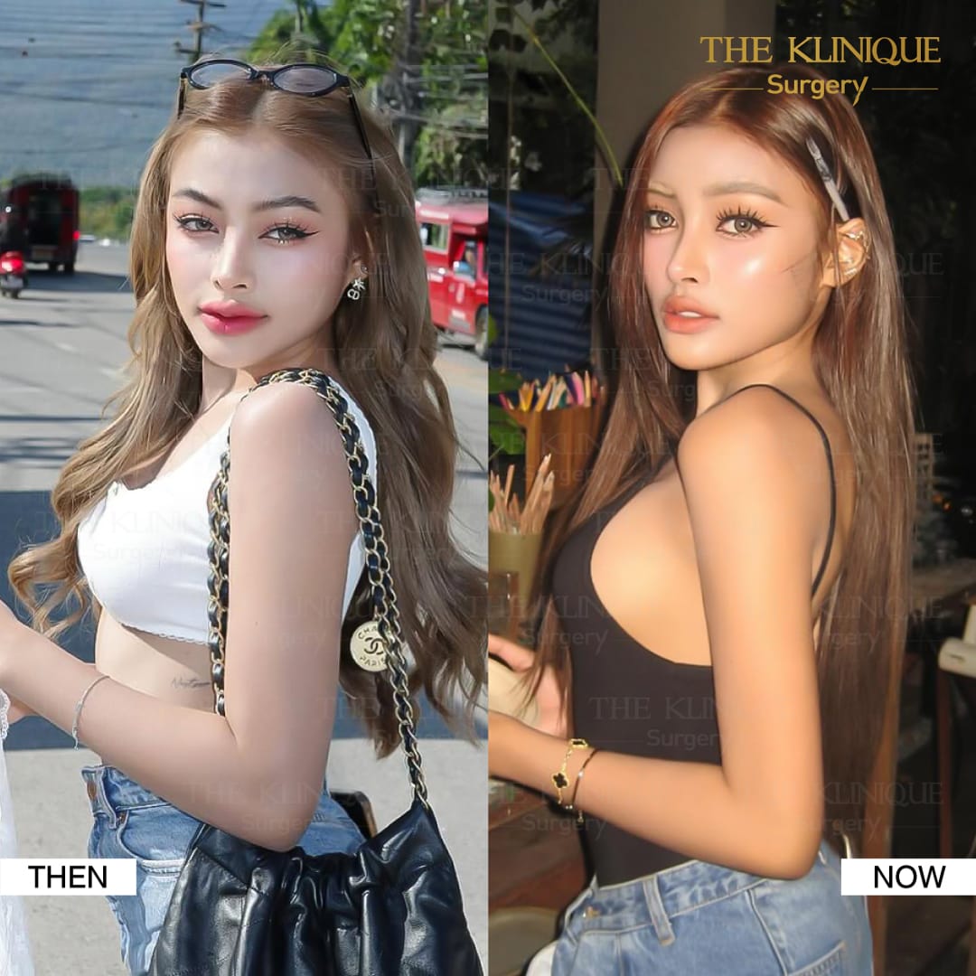 Liposuction-Review-Getting-NewBody-NestySpicy