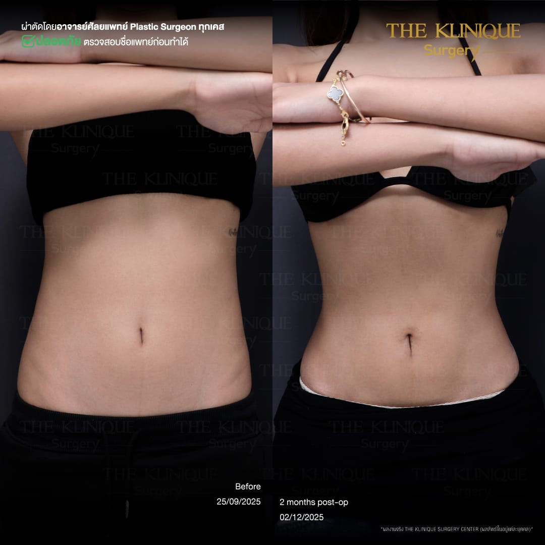 Liposuction-Review-Getting-NewBody-NestySpicy