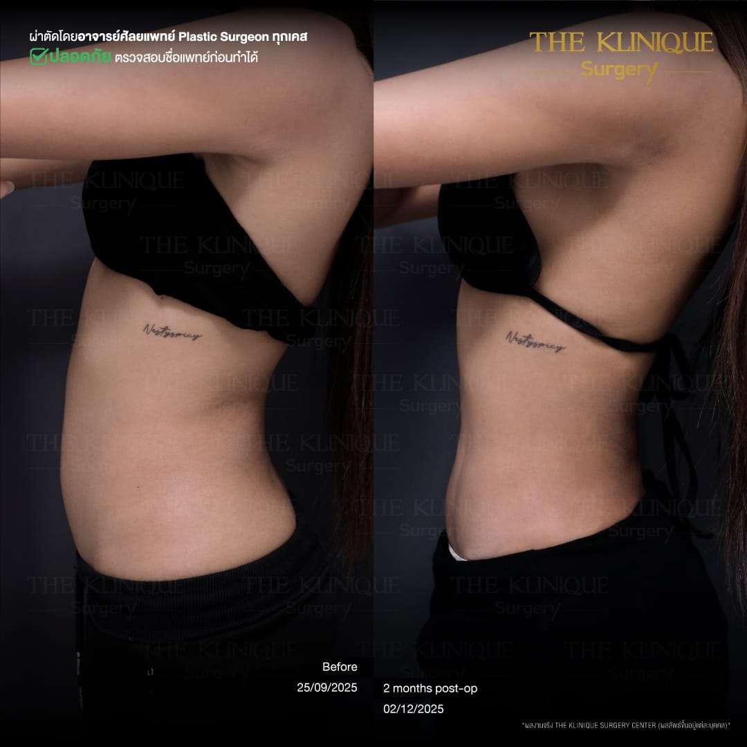 Liposuction-Review-Getting-NewBody-NestySpicy