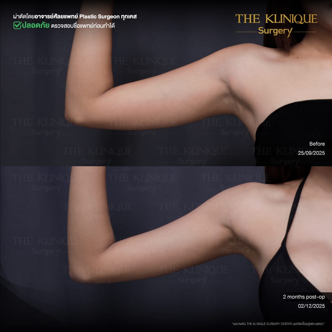 Liposuction-Review-Getting-NewBody-NestySpicy