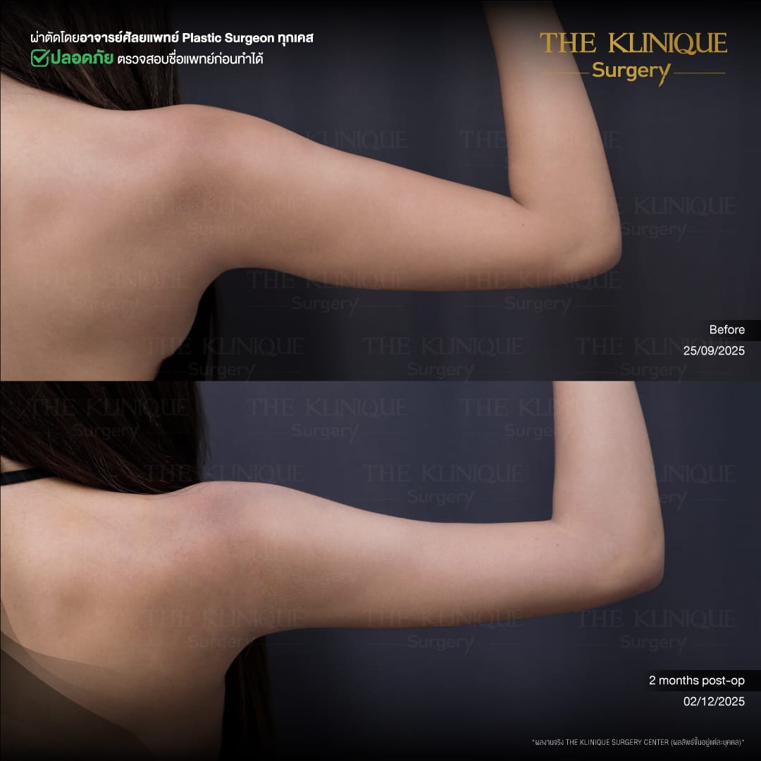 Liposuction-Review-Getting-NewBody-NestySpicy