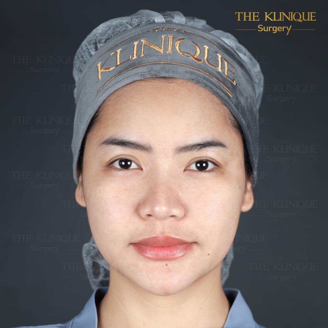 ศัลยกรรมตา, ศัลยกรรมตาสองชั้น, ศัลยกรรมตาสองชั้น ราคา, ศัลยกรรมตาที่ไหนดี, ศัลยกรรมตามีกี่แบบ, ตาสองชั้น, ตาสองชั้นหลบใน, คลินิกทำตา, ตาสองชั้นที่ไหนดี, ตาสองชั้นแบบกรีดสั้น กรีดยาว, กล้ามเนื้อตาอ่อนแรง, แก้ตา, แก้ตาสองชั้น, แก้หนังตาตก, แก้ชั้นตาใหญ่, แก้ตาไม่เท่ากัน, หนังตาตก, แก้หนังตาตก,Ophthalmologis,จักษุศัลยแพทย์,คลินิกทำตาสองชั้น ใจกลางสยามสแคว์ , แก้ตาอ่อนแรง ใจกลางสยาม,ตาง่วง, ตาปรือ, ทำตาสองชั้นที่ไหนดี, แพทย์ Oculoplastic, มัดกล้ามเนื้อตา, รีวิวแก้กล้ามเนื้อตาอ่อนแรง, แก้ไขกล้ามเนื้อตาอ่อนแรง