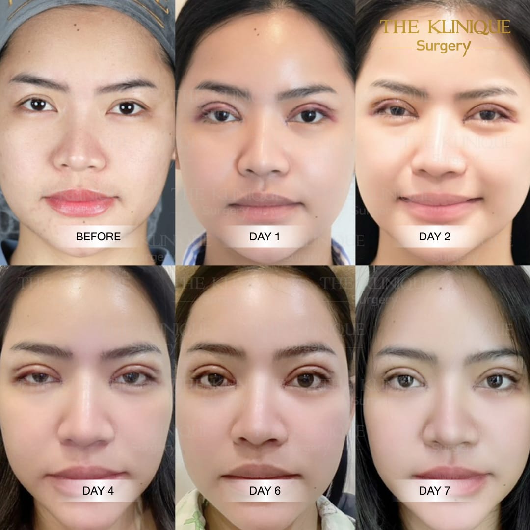 ศัลยกรรมตา, ศัลยกรรมตาสองชั้น, ศัลยกรรมตาสองชั้น ราคา, ศัลยกรรมตาที่ไหนดี, ศัลยกรรมตามีกี่แบบ, ตาสองชั้น, ตาสองชั้นหลบใน, คลินิกทำตา, ตาสองชั้นที่ไหนดี, ตาสองชั้นแบบกรีดสั้น กรีดยาว, กล้ามเนื้อตาอ่อนแรง, แก้ตา, แก้ตาสองชั้น, แก้หนังตาตก, แก้ชั้นตาใหญ่, แก้ตาไม่เท่ากัน, หนังตาตก, แก้หนังตาตก,Ophthalmologis,จักษุศัลยแพทย์,คลินิกทำตาสองชั้น ใจกลางสยามสแคว์ , แก้ตาอ่อนแรง ใจกลางสยาม,ตาง่วง, ตาปรือ, ทำตาสองชั้นที่ไหนดี, แพทย์ Oculoplastic, มัดกล้ามเนื้อตา, รีวิวแก้กล้ามเนื้อตาอ่อนแรง, แก้ไขกล้ามเนื้อตาอ่อนแรง