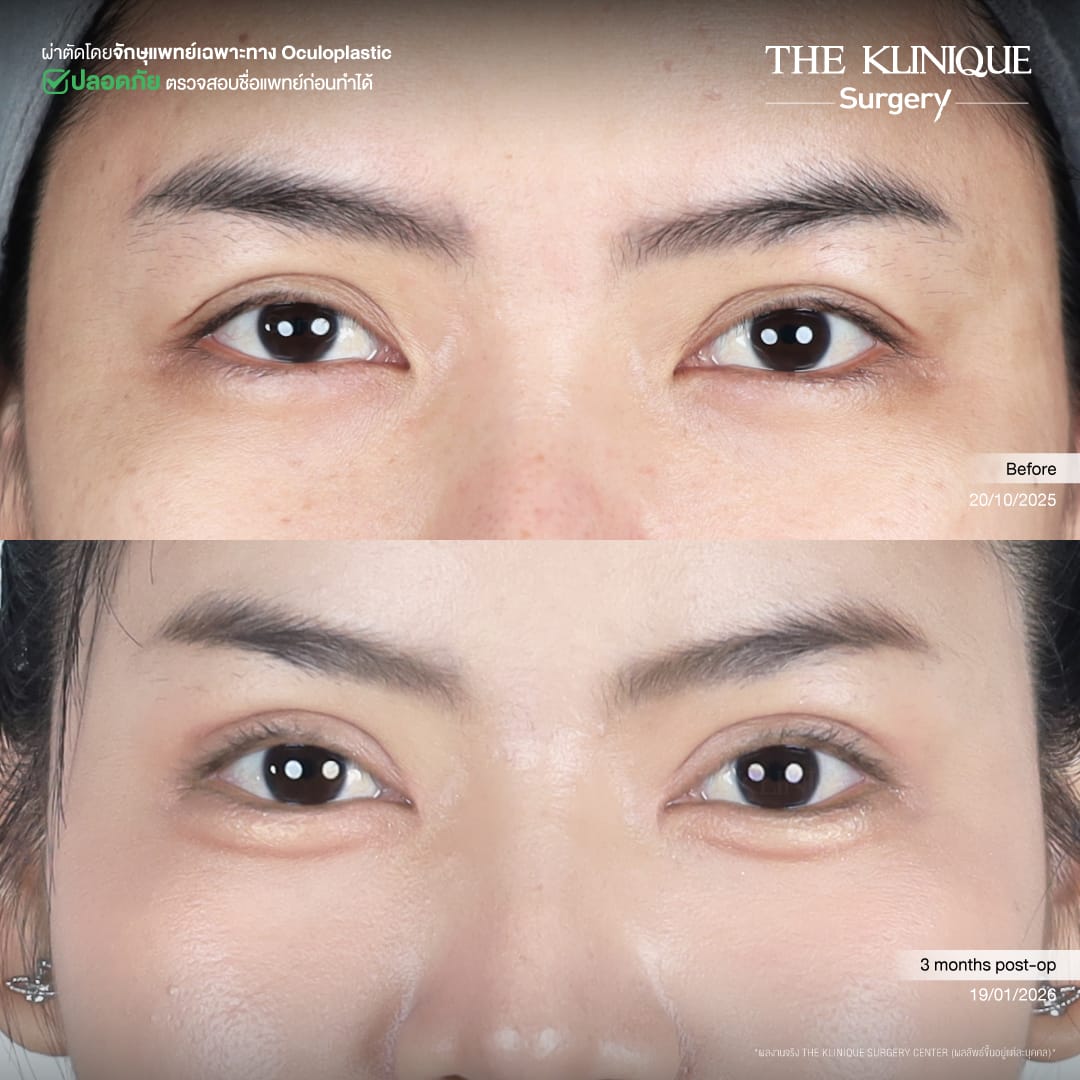 ศัลยกรรมตา, ศัลยกรรมตาสองชั้น, ศัลยกรรมตาสองชั้น ราคา, ศัลยกรรมตาที่ไหนดี, ศัลยกรรมตามีกี่แบบ, ตาสองชั้น, ตาสองชั้นหลบใน, คลินิกทำตา, ตาสองชั้นที่ไหนดี, ตาสองชั้นแบบกรีดสั้น กรีดยาว, กล้ามเนื้อตาอ่อนแรง, แก้ตา, แก้ตาสองชั้น, แก้หนังตาตก, แก้ชั้นตาใหญ่, แก้ตาไม่เท่ากัน, หนังตาตก, แก้หนังตาตก,Ophthalmologis,จักษุศัลยแพทย์,คลินิกทำตาสองชั้น ใจกลางสยามสแคว์ , แก้ตาอ่อนแรง ใจกลางสยาม,ตาง่วง, ตาปรือ, ทำตาสองชั้นที่ไหนดี, แพทย์ Oculoplastic, มัดกล้ามเนื้อตา, รีวิวแก้กล้ามเนื้อตาอ่อนแรง, แก้ไขกล้ามเนื้อตาอ่อนแรง