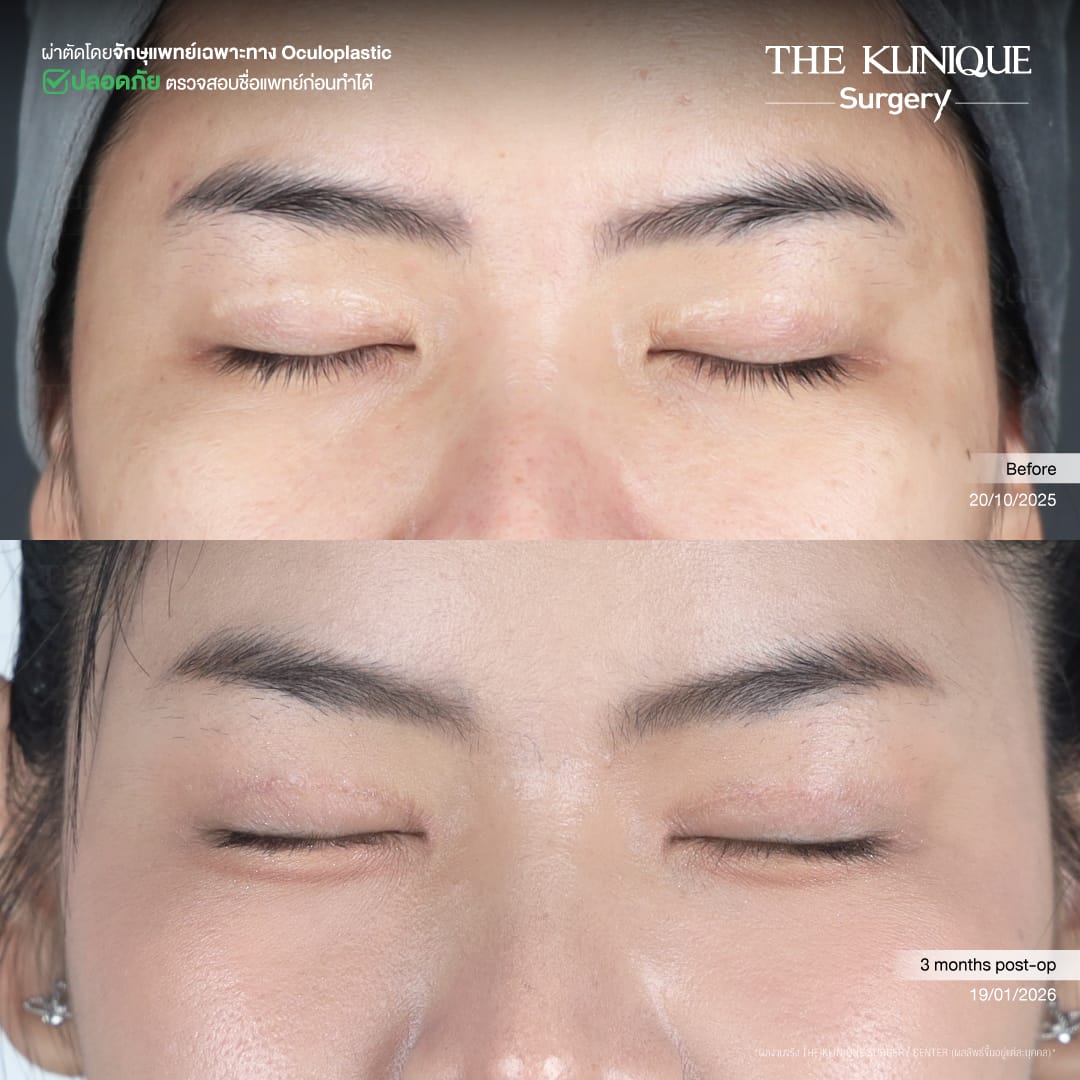 ศัลยกรรมตา, ศัลยกรรมตาสองชั้น, ศัลยกรรมตาสองชั้น ราคา, ศัลยกรรมตาที่ไหนดี, ศัลยกรรมตามีกี่แบบ, ตาสองชั้น, ตาสองชั้นหลบใน, คลินิกทำตา, ตาสองชั้นที่ไหนดี, ตาสองชั้นแบบกรีดสั้น กรีดยาว, กล้ามเนื้อตาอ่อนแรง, แก้ตา, แก้ตาสองชั้น, แก้หนังตาตก, แก้ชั้นตาใหญ่, แก้ตาไม่เท่ากัน, หนังตาตก, แก้หนังตาตก,Ophthalmologis,จักษุศัลยแพทย์,คลินิกทำตาสองชั้น ใจกลางสยามสแคว์ , แก้ตาอ่อนแรง ใจกลางสยาม,ตาง่วง, ตาปรือ, ทำตาสองชั้นที่ไหนดี, แพทย์ Oculoplastic, มัดกล้ามเนื้อตา, รีวิวแก้กล้ามเนื้อตาอ่อนแรง, แก้ไขกล้ามเนื้อตาอ่อนแรง