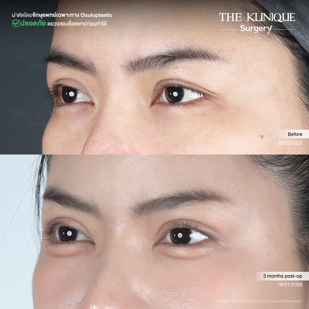 ศัลยกรรมตา, ศัลยกรรมตาสองชั้น, ศัลยกรรมตาสองชั้น ราคา, ศัลยกรรมตาที่ไหนดี, ศัลยกรรมตามีกี่แบบ, ตาสองชั้น, ตาสองชั้นหลบใน, คลินิกทำตา, ตาสองชั้นที่ไหนดี, ตาสองชั้นแบบกรีดสั้น กรีดยาว, กล้ามเนื้อตาอ่อนแรง, แก้ตา, แก้ตาสองชั้น, แก้หนังตาตก, แก้ชั้นตาใหญ่, แก้ตาไม่เท่ากัน, หนังตาตก, แก้หนังตาตก,Ophthalmologis,จักษุศัลยแพทย์,คลินิกทำตาสองชั้น ใจกลางสยามสแคว์ , แก้ตาอ่อนแรง ใจกลางสยาม,ตาง่วง, ตาปรือ, ทำตาสองชั้นที่ไหนดี, แพทย์ Oculoplastic, มัดกล้ามเนื้อตา, รีวิวแก้กล้ามเนื้อตาอ่อนแรง, แก้ไขกล้ามเนื้อตาอ่อนแรง