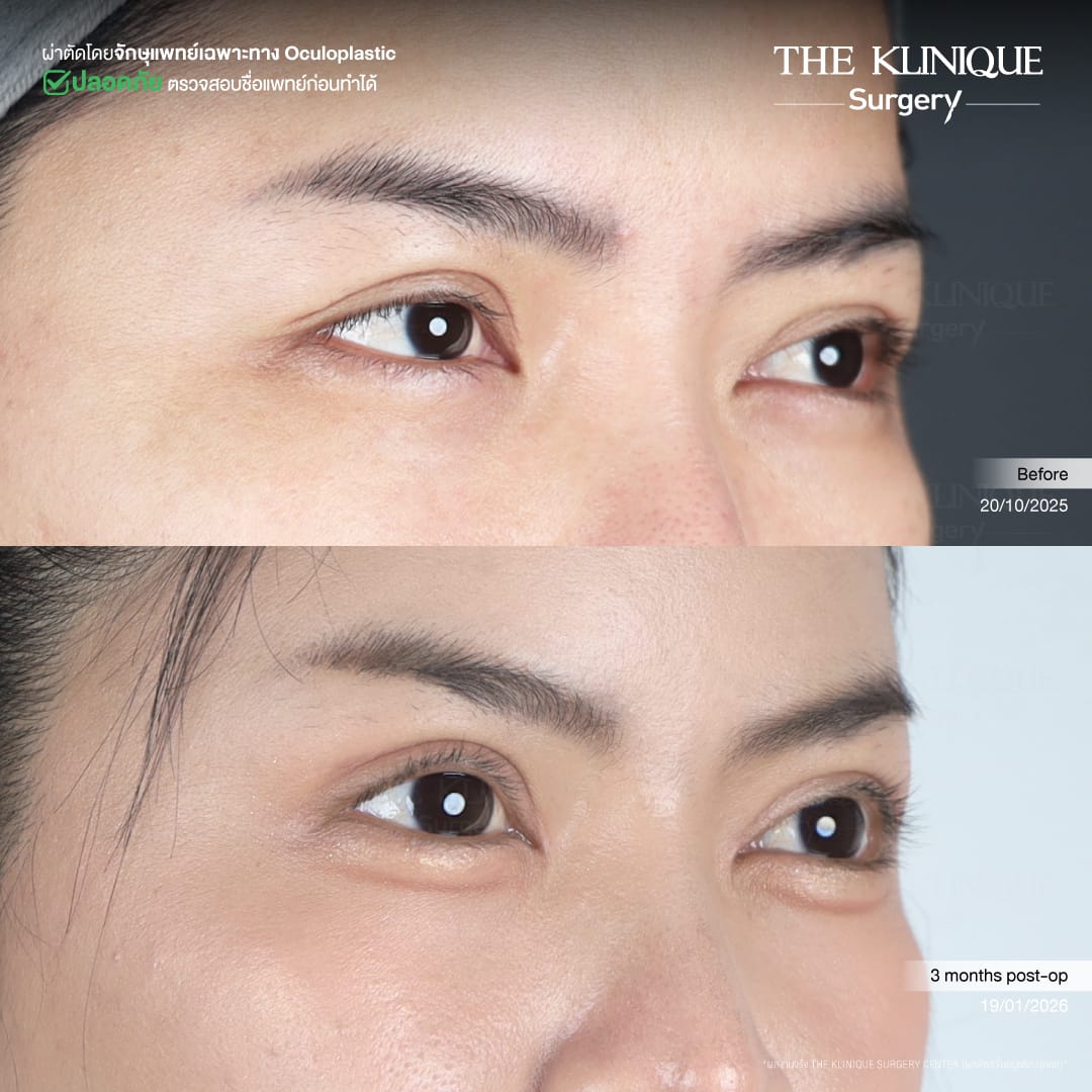 ศัลยกรรมตา, ศัลยกรรมตาสองชั้น, ศัลยกรรมตาสองชั้น ราคา, ศัลยกรรมตาที่ไหนดี, ศัลยกรรมตามีกี่แบบ, ตาสองชั้น, ตาสองชั้นหลบใน, คลินิกทำตา, ตาสองชั้นที่ไหนดี, ตาสองชั้นแบบกรีดสั้น กรีดยาว, กล้ามเนื้อตาอ่อนแรง, แก้ตา, แก้ตาสองชั้น, แก้หนังตาตก, แก้ชั้นตาใหญ่, แก้ตาไม่เท่ากัน, หนังตาตก, แก้หนังตาตก,Ophthalmologis,จักษุศัลยแพทย์,คลินิกทำตาสองชั้น ใจกลางสยามสแคว์ , แก้ตาอ่อนแรง ใจกลางสยาม,ตาง่วง, ตาปรือ, ทำตาสองชั้นที่ไหนดี, แพทย์ Oculoplastic, มัดกล้ามเนื้อตา, รีวิวแก้กล้ามเนื้อตาอ่อนแรง, แก้ไขกล้ามเนื้อตาอ่อนแรง