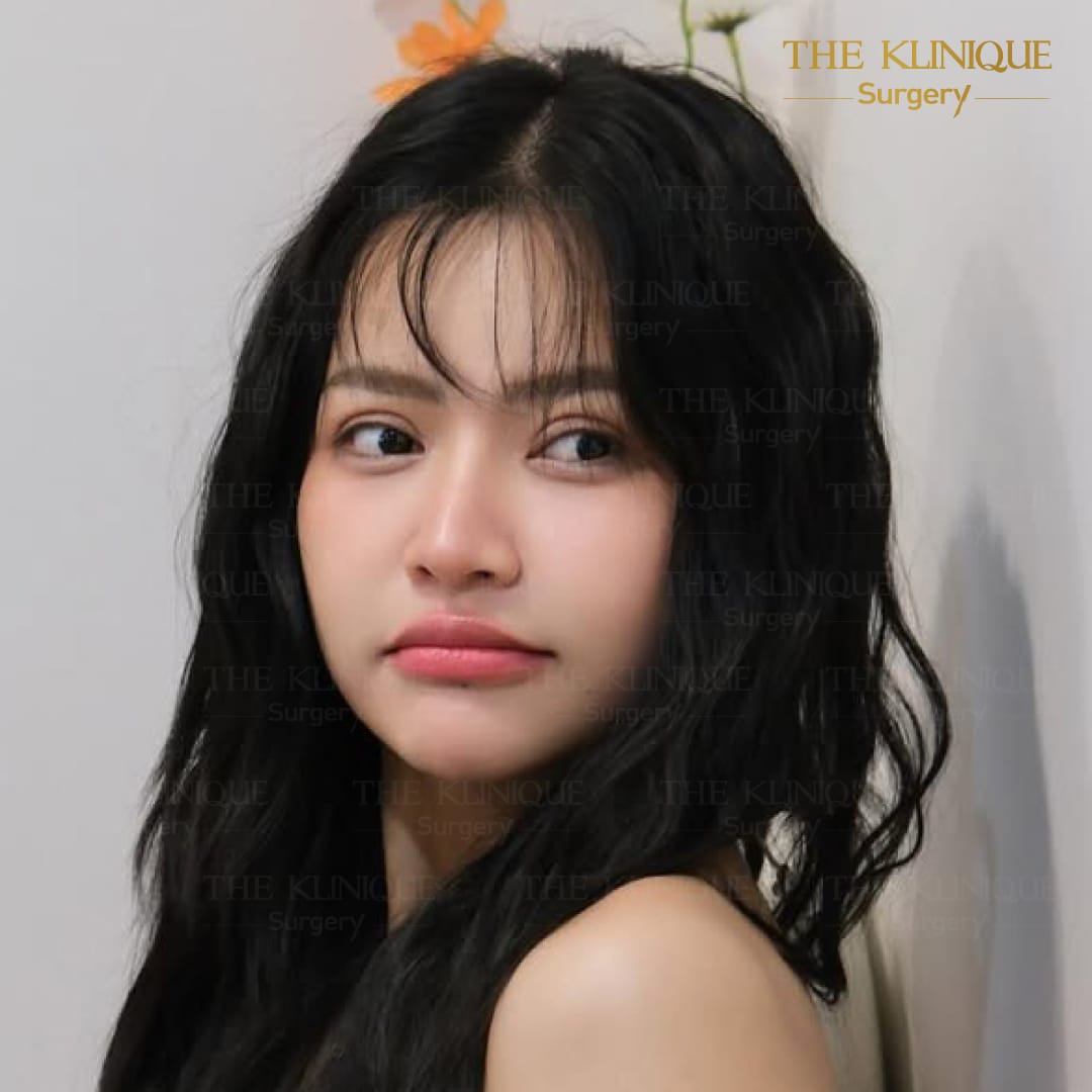 ศัลยกรรมตา, ศัลยกรรมตาสองชั้น, ศัลยกรรมตาสองชั้น ราคา, ศัลยกรรมตาที่ไหนดี, ศัลยกรรมตามีกี่แบบ, ตาสองชั้น, ตาสองชั้นหลบใน, คลินิกทำตา, ตาสองชั้นที่ไหนดี, ตาสองชั้นแบบกรีดสั้น กรีดยาว, กล้ามเนื้อตาอ่อนแรง, แก้ตา, แก้ตาสองชั้น, แก้หนังตาตก, แก้ชั้นตาใหญ่, แก้ตาไม่เท่ากัน, หนังตาตก, แก้หนังตาตก,Ophthalmologis,จักษุศัลยแพทย์,คลินิกทำตาสองชั้น ใจกลางสยามสแคว์ , แก้ตาอ่อนแรง ใจกลางสยาม,ตาง่วง, ตาปรือ, ทำตาสองชั้นที่ไหนดี, แพทย์ Oculoplastic, มัดกล้ามเนื้อตา, รีวิวแก้กล้ามเนื้อตาอ่อนแรง, แก้ไขกล้ามเนื้อตาอ่อนแรง