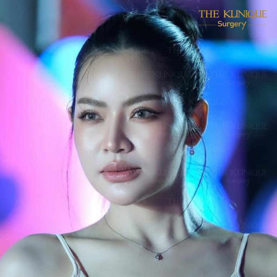 ศัลยกรรมตา, ศัลยกรรมตาสองชั้น, ศัลยกรรมตาสองชั้น ราคา, ศัลยกรรมตาที่ไหนดี, ศัลยกรรมตามีกี่แบบ, ตาสองชั้น, ตาสองชั้นหลบใน, คลินิกทำตา, ตาสองชั้นที่ไหนดี, ตาสองชั้นแบบกรีดสั้น กรีดยาว, กล้ามเนื้อตาอ่อนแรง, แก้ตา, แก้ตาสองชั้น, แก้หนังตาตก, แก้ชั้นตาใหญ่, แก้ตาไม่เท่ากัน, หนังตาตก, แก้หนังตาตก,Ophthalmologis,จักษุศัลยแพทย์,คลินิกทำตาสองชั้น ใจกลางสยามสแคว์ , แก้ตาอ่อนแรง ใจกลางสยาม,ตาง่วง, ตาปรือ, ทำตาสองชั้นที่ไหนดี, แพทย์ Oculoplastic, มัดกล้ามเนื้อตา, รีวิวแก้กล้ามเนื้อตาอ่อนแรง, แก้ไขกล้ามเนื้อตาอ่อนแรง