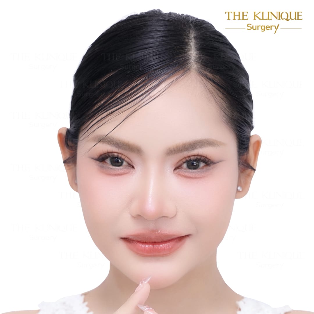 ศัลยกรรมตา, ศัลยกรรมตาสองชั้น, ศัลยกรรมตาสองชั้น ราคา, ศัลยกรรมตาที่ไหนดี, ศัลยกรรมตามีกี่แบบ, ตาสองชั้น, ตาสองชั้นหลบใน, คลินิกทำตา, ตาสองชั้นที่ไหนดี, ตาสองชั้นแบบกรีดสั้น กรีดยาว, กล้ามเนื้อตาอ่อนแรง, แก้ตา, แก้ตาสองชั้น, แก้หนังตาตก, แก้ชั้นตาใหญ่, แก้ตาไม่เท่ากัน, หนังตาตก, แก้หนังตาตก,Ophthalmologis,จักษุศัลยแพทย์,คลินิกทำตาสองชั้น ใจกลางสยามสแคว์ , แก้ตาอ่อนแรง ใจกลางสยาม,ตาง่วง, ตาปรือ, ทำตาสองชั้นที่ไหนดี, แพทย์ Oculoplastic, มัดกล้ามเนื้อตา, รีวิวแก้กล้ามเนื้อตาอ่อนแรง, แก้ไขกล้ามเนื้อตาอ่อนแรง