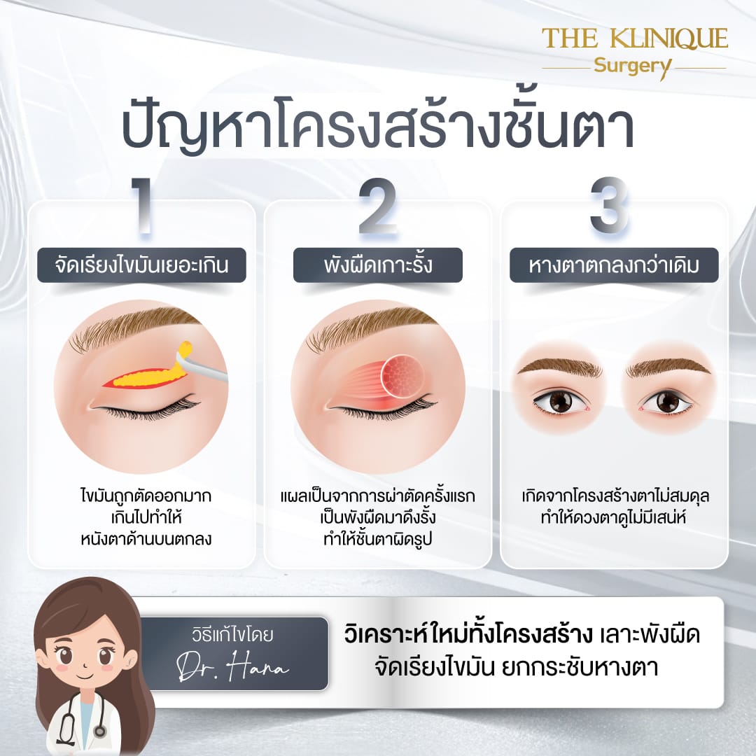 ศัลยกรรมตา, ศัลยกรรมตาสองชั้น, ศัลยกรรมตาสองชั้น ราคา, ศัลยกรรมตาที่ไหนดี, ศัลยกรรมตามีกี่แบบ, ตาสองชั้น, ตาสองชั้นหลบใน, คลินิกทำตา, ตาสองชั้นที่ไหนดี, ตาสองชั้นแบบกรีดสั้น กรีดยาว, กล้ามเนื้อตาอ่อนแรง, แก้ตา, แก้ตาสองชั้น, แก้หนังตาตก, แก้ชั้นตาใหญ่, แก้ตาไม่เท่ากัน, หนังตาตก, แก้หนังตาตก,Ophthalmologis,จักษุศัลยแพทย์,คลินิกทำตาสองชั้น ใจกลางสยามสแคว์ , แก้ตาอ่อนแรง ใจกลางสยาม,ตาง่วง, ตาปรือ, ทำตาสองชั้นที่ไหนดี, แพทย์ Oculoplastic, มัดกล้ามเนื้อตา, รีวิวแก้กล้ามเนื้อตาอ่อนแรง, แก้ไขกล้ามเนื้อตาอ่อนแรง