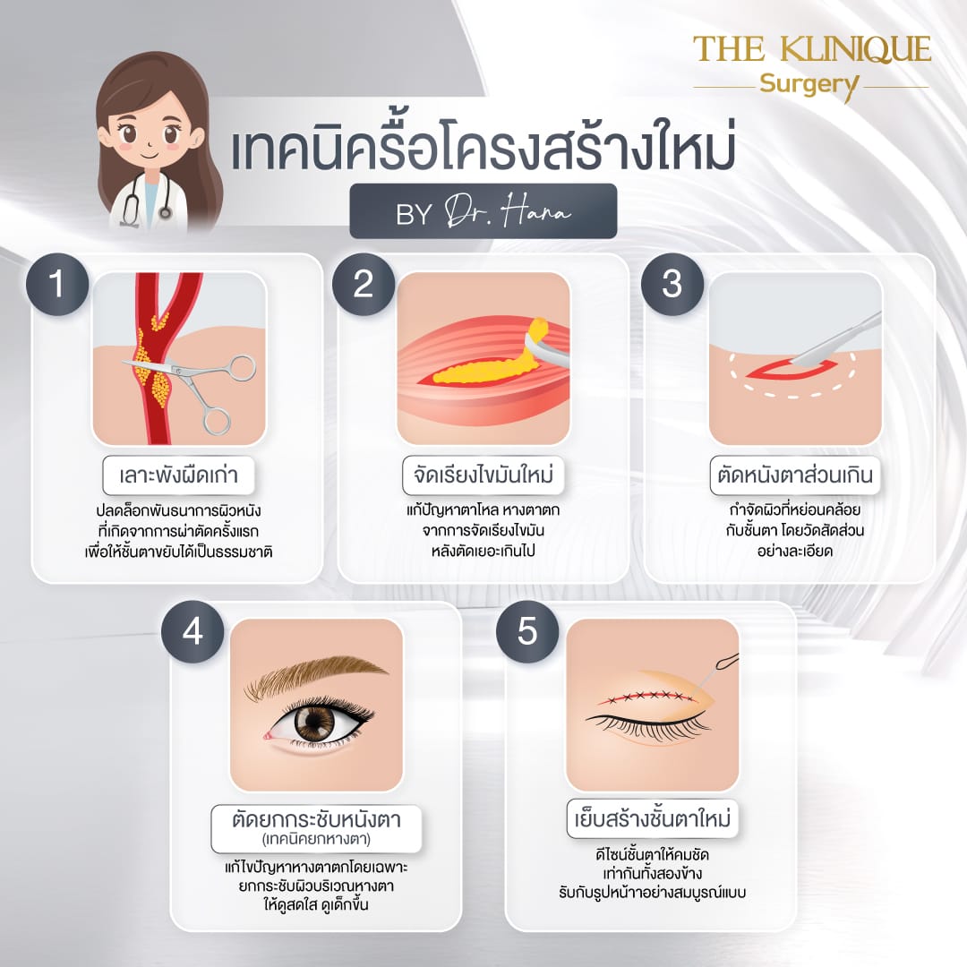 ศัลยกรรมตา, ศัลยกรรมตาสองชั้น, ศัลยกรรมตาสองชั้น ราคา, ศัลยกรรมตาที่ไหนดี, ศัลยกรรมตามีกี่แบบ, ตาสองชั้น, ตาสองชั้นหลบใน, คลินิกทำตา, ตาสองชั้นที่ไหนดี, ตาสองชั้นแบบกรีดสั้น กรีดยาว, กล้ามเนื้อตาอ่อนแรง, แก้ตา, แก้ตาสองชั้น, แก้หนังตาตก, แก้ชั้นตาใหญ่, แก้ตาไม่เท่ากัน, หนังตาตก, แก้หนังตาตก,Ophthalmologis,จักษุศัลยแพทย์,คลินิกทำตาสองชั้น ใจกลางสยามสแคว์ , แก้ตาอ่อนแรง ใจกลางสยาม,ตาง่วง, ตาปรือ, ทำตาสองชั้นที่ไหนดี, แพทย์ Oculoplastic, มัดกล้ามเนื้อตา, รีวิวแก้กล้ามเนื้อตาอ่อนแรง, แก้ไขกล้ามเนื้อตาอ่อนแรง