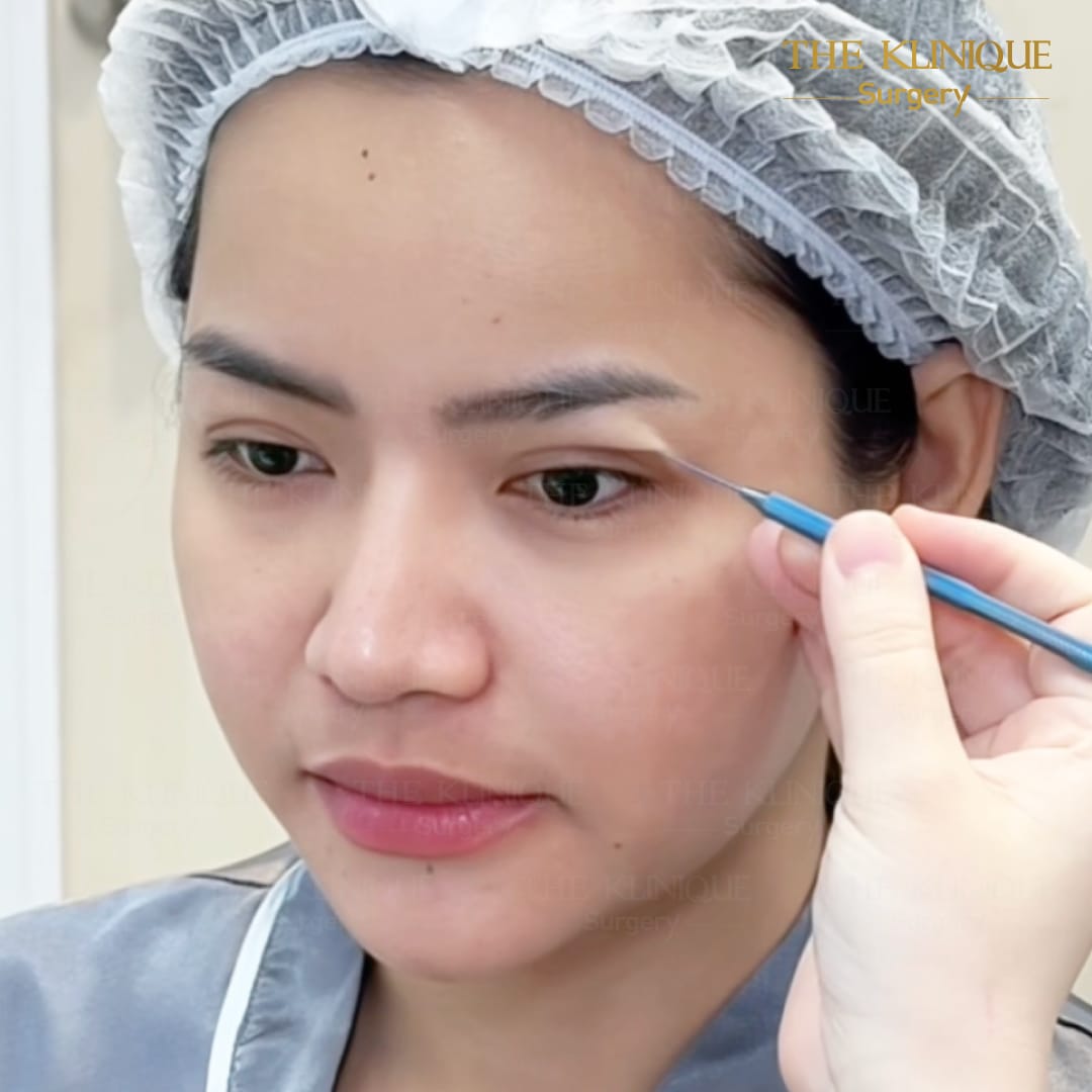 ศัลยกรรมตา, ศัลยกรรมตาสองชั้น, ศัลยกรรมตาสองชั้น ราคา, ศัลยกรรมตาที่ไหนดี, ศัลยกรรมตามีกี่แบบ, ตาสองชั้น, ตาสองชั้นหลบใน, คลินิกทำตา, ตาสองชั้นที่ไหนดี, ตาสองชั้นแบบกรีดสั้น กรีดยาว, กล้ามเนื้อตาอ่อนแรง, แก้ตา, แก้ตาสองชั้น, แก้หนังตาตก, แก้ชั้นตาใหญ่, แก้ตาไม่เท่ากัน, หนังตาตก, แก้หนังตาตก,Ophthalmologis,จักษุศัลยแพทย์,คลินิกทำตาสองชั้น ใจกลางสยามสแคว์ , แก้ตาอ่อนแรง ใจกลางสยาม,ตาง่วง, ตาปรือ, ทำตาสองชั้นที่ไหนดี, แพทย์ Oculoplastic, มัดกล้ามเนื้อตา, รีวิวแก้กล้ามเนื้อตาอ่อนแรง, แก้ไขกล้ามเนื้อตาอ่อนแรง