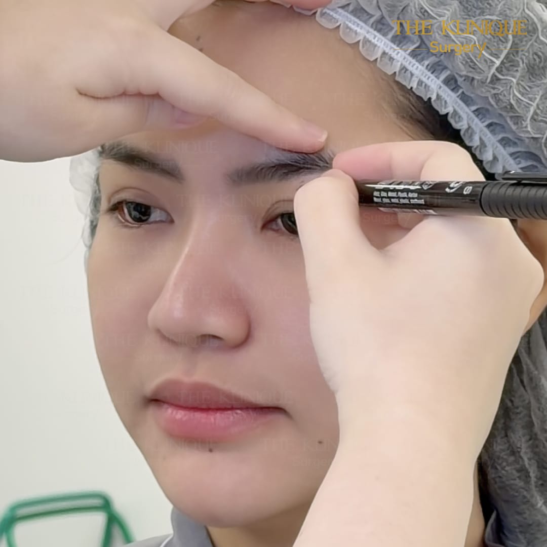 ศัลยกรรมตา, ศัลยกรรมตาสองชั้น, ศัลยกรรมตาสองชั้น ราคา, ศัลยกรรมตาที่ไหนดี, ศัลยกรรมตามีกี่แบบ, ตาสองชั้น, ตาสองชั้นหลบใน, คลินิกทำตา, ตาสองชั้นที่ไหนดี, ตาสองชั้นแบบกรีดสั้น กรีดยาว, กล้ามเนื้อตาอ่อนแรง, แก้ตา, แก้ตาสองชั้น, แก้หนังตาตก, แก้ชั้นตาใหญ่, แก้ตาไม่เท่ากัน, หนังตาตก, แก้หนังตาตก,Ophthalmologis,จักษุศัลยแพทย์,คลินิกทำตาสองชั้น ใจกลางสยามสแคว์ , แก้ตาอ่อนแรง ใจกลางสยาม,ตาง่วง, ตาปรือ, ทำตาสองชั้นที่ไหนดี, แพทย์ Oculoplastic, มัดกล้ามเนื้อตา, รีวิวแก้กล้ามเนื้อตาอ่อนแรง, แก้ไขกล้ามเนื้อตาอ่อนแรง