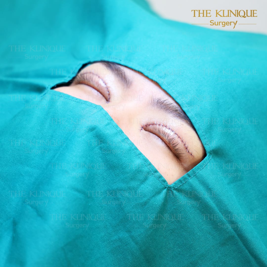 ศัลยกรรมตา, ศัลยกรรมตาสองชั้น, ศัลยกรรมตาสองชั้น ราคา, ศัลยกรรมตาที่ไหนดี, ศัลยกรรมตามีกี่แบบ, ตาสองชั้น, ตาสองชั้นหลบใน, คลินิกทำตา, ตาสองชั้นที่ไหนดี, ตาสองชั้นแบบกรีดสั้น กรีดยาว, กล้ามเนื้อตาอ่อนแรง, แก้ตา, แก้ตาสองชั้น, แก้หนังตาตก, แก้ชั้นตาใหญ่, แก้ตาไม่เท่ากัน, หนังตาตก, แก้หนังตาตก,Ophthalmologis,จักษุศัลยแพทย์,คลินิกทำตาสองชั้น ใจกลางสยามสแคว์ , แก้ตาอ่อนแรง ใจกลางสยาม,ตาง่วง, ตาปรือ, ทำตาสองชั้นที่ไหนดี, แพทย์ Oculoplastic, มัดกล้ามเนื้อตา, รีวิวแก้กล้ามเนื้อตาอ่อนแรง, แก้ไขกล้ามเนื้อตาอ่อนแรง