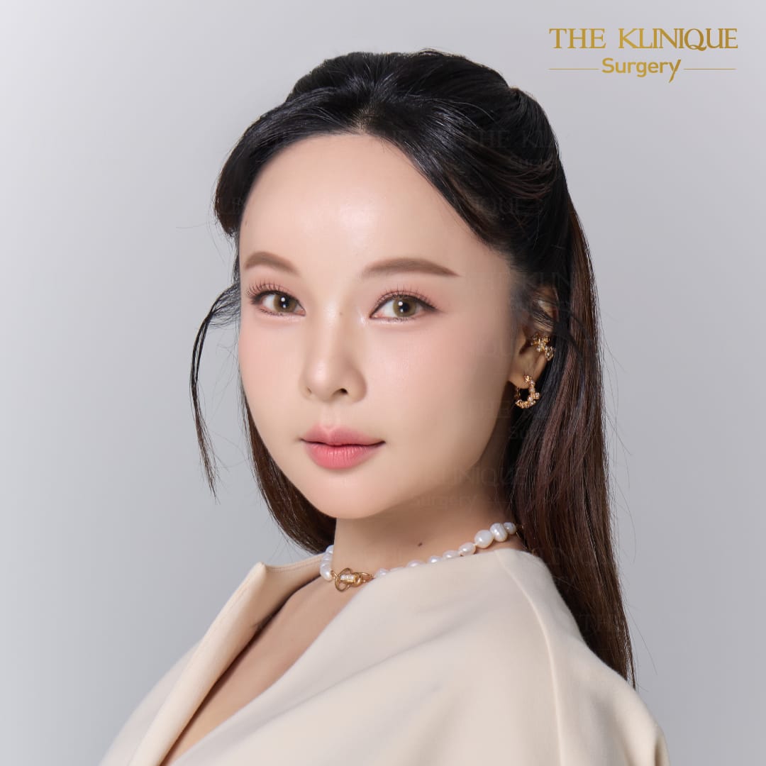 facelift review 10-year younger look before and after skin tightening procedure