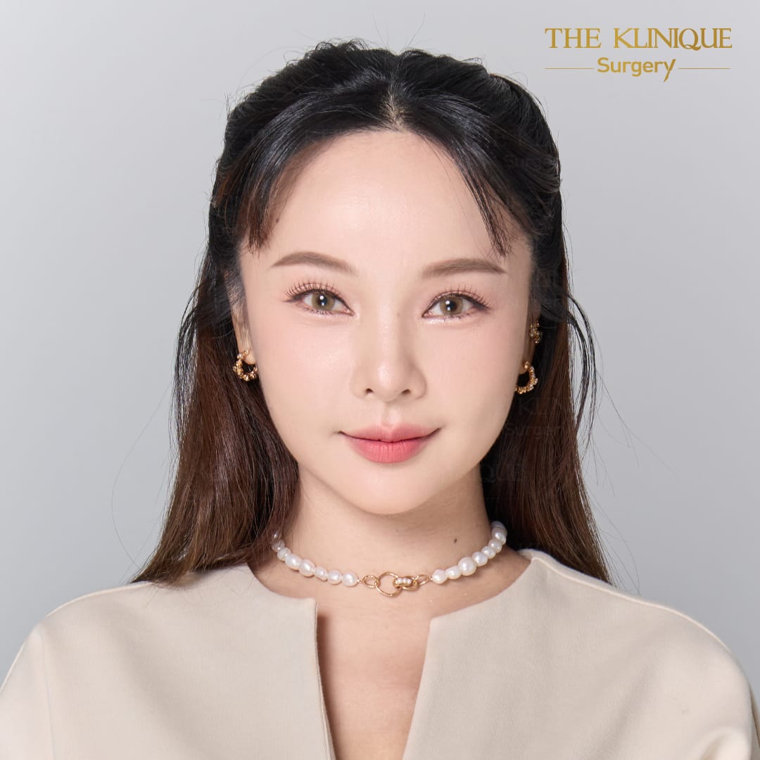 facelift review 10-year younger look before and after skin tightening procedure