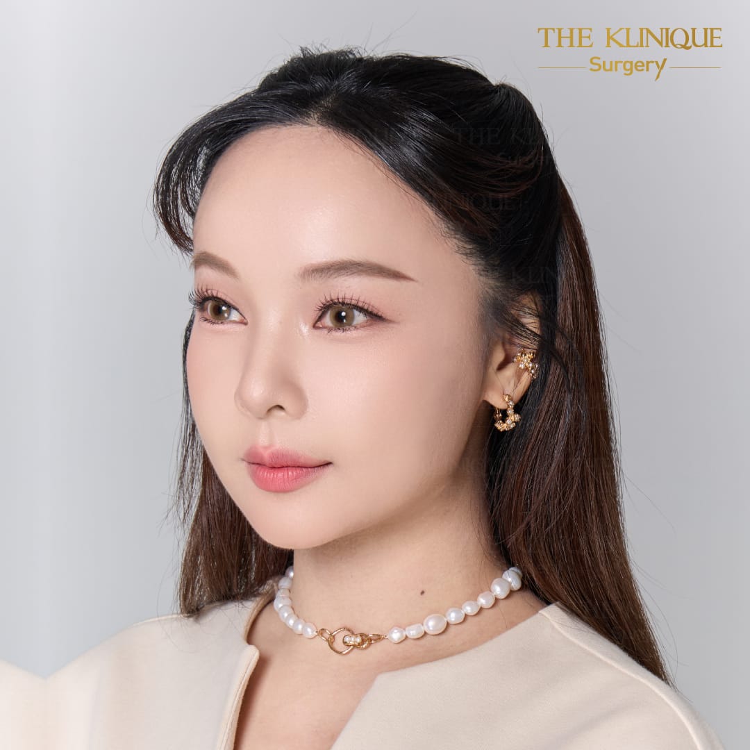 facelift review 10-year younger look before and after skin tightening procedure