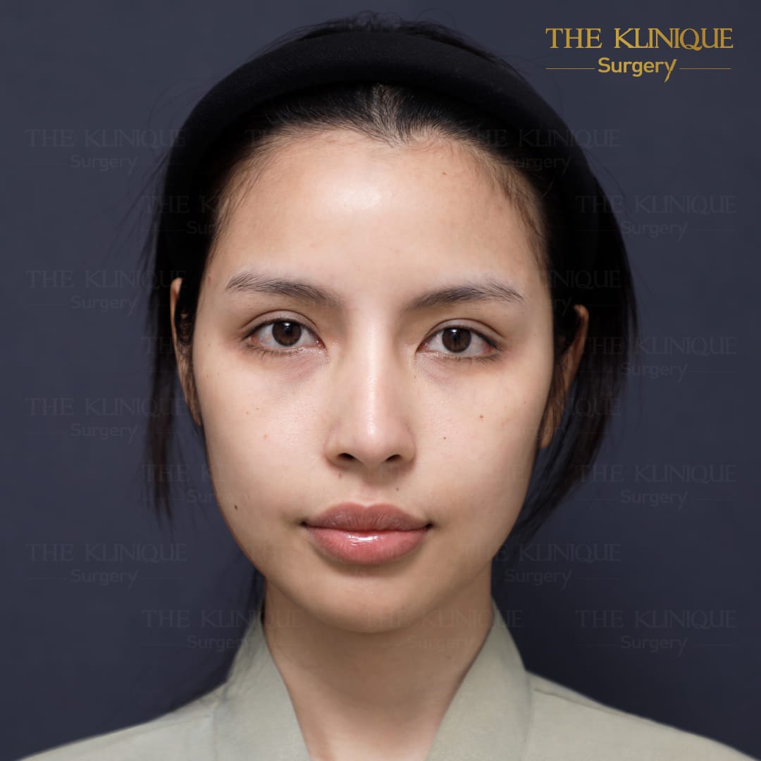 facelift review 10-year younger look before and after skin tightening procedure