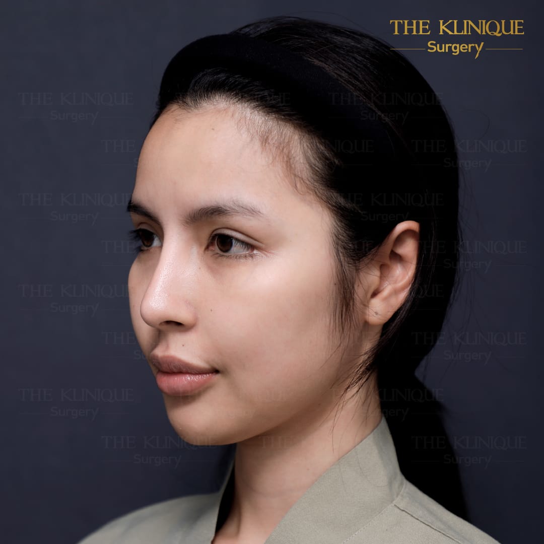 facelift review 10-year younger look before and after skin tightening procedure