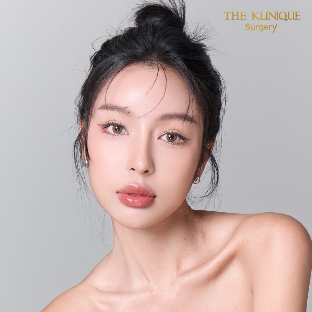 facelift review 10-year younger look before and after skin tightening procedure