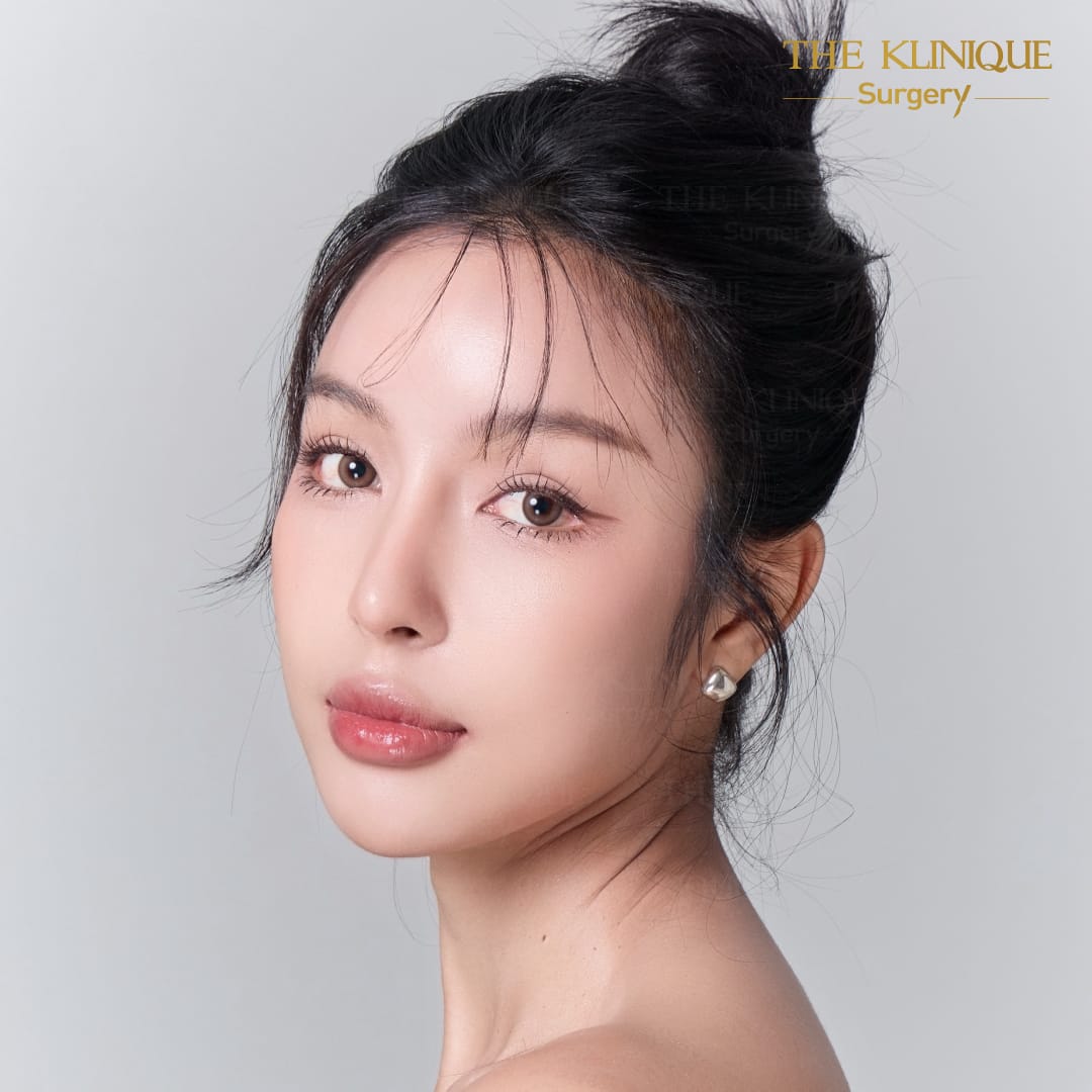 facelift review 10-year younger look before and after skin tightening procedure