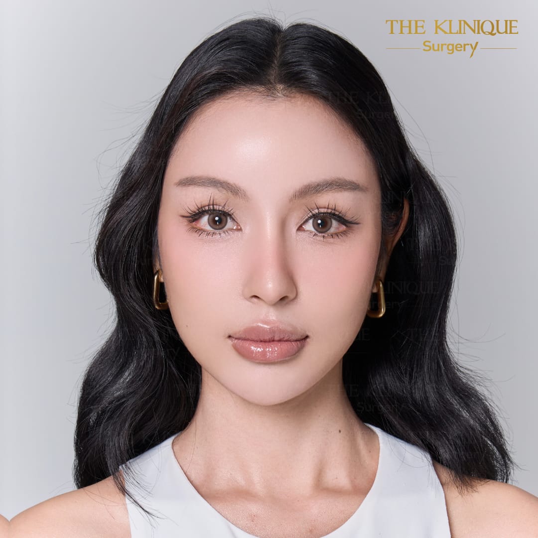 facelift review 10-year younger look before and after skin tightening procedure