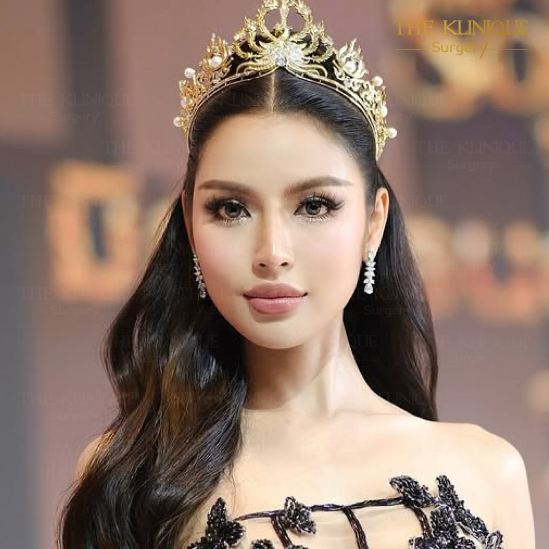 facelift review 10-year younger look before and after skin tightening procedure