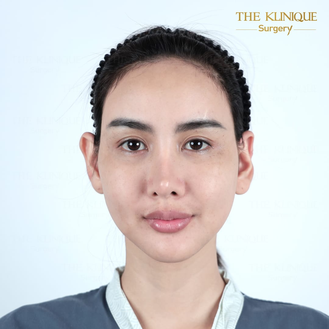 facelift review 10-year younger look before and after skin tightening procedure