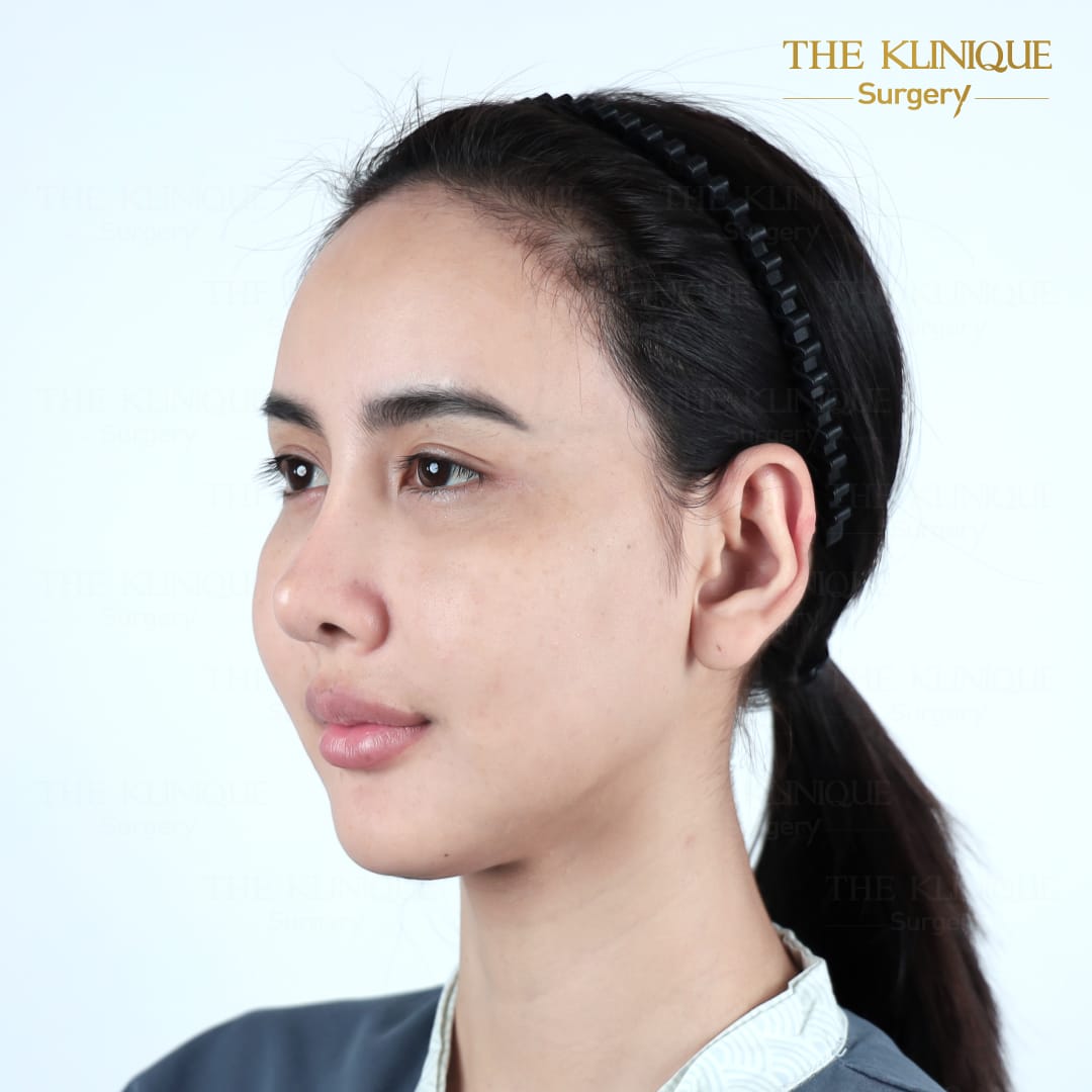 facelift review 10-year younger look before and after skin tightening procedure