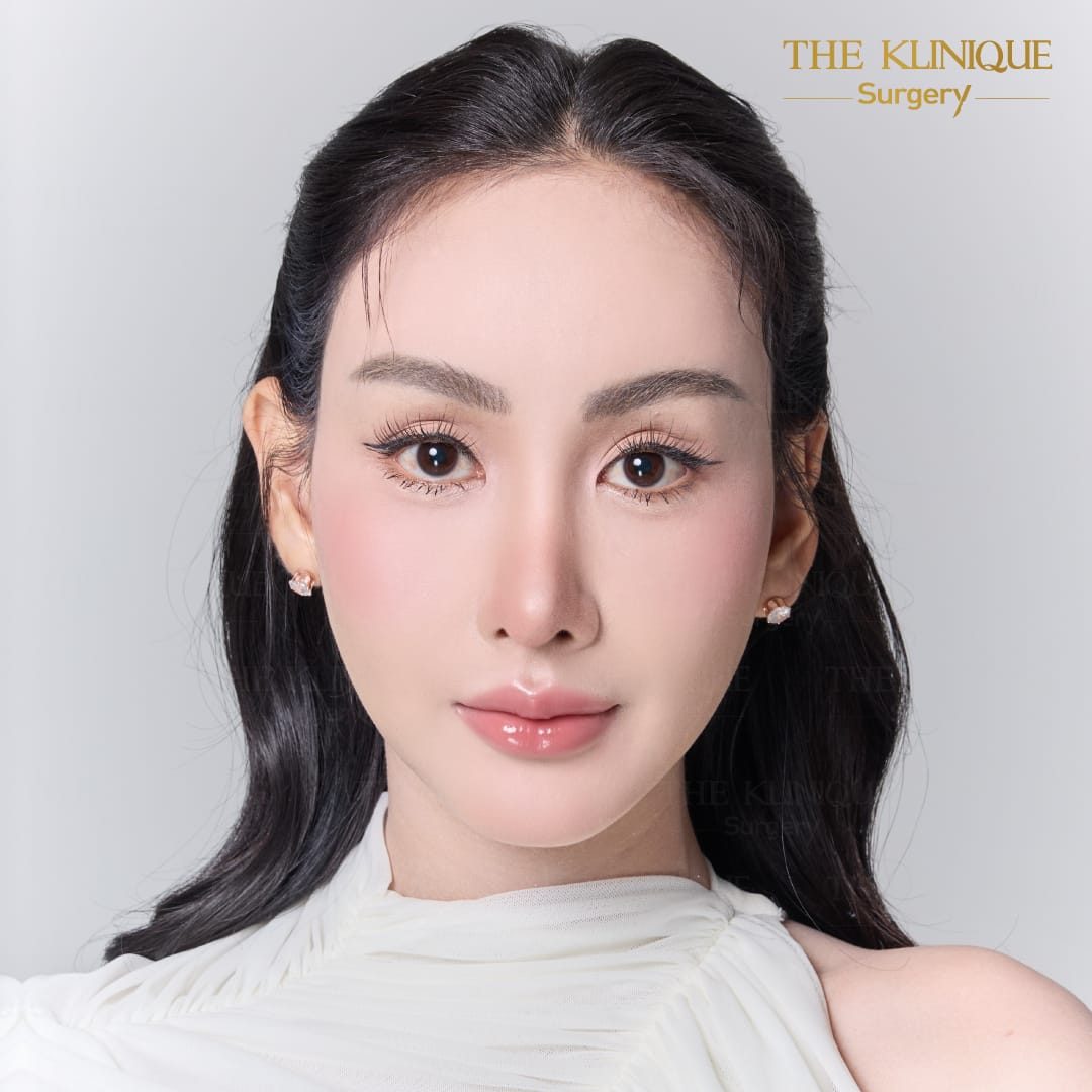 facelift review 10-year younger look before and after skin tightening procedure