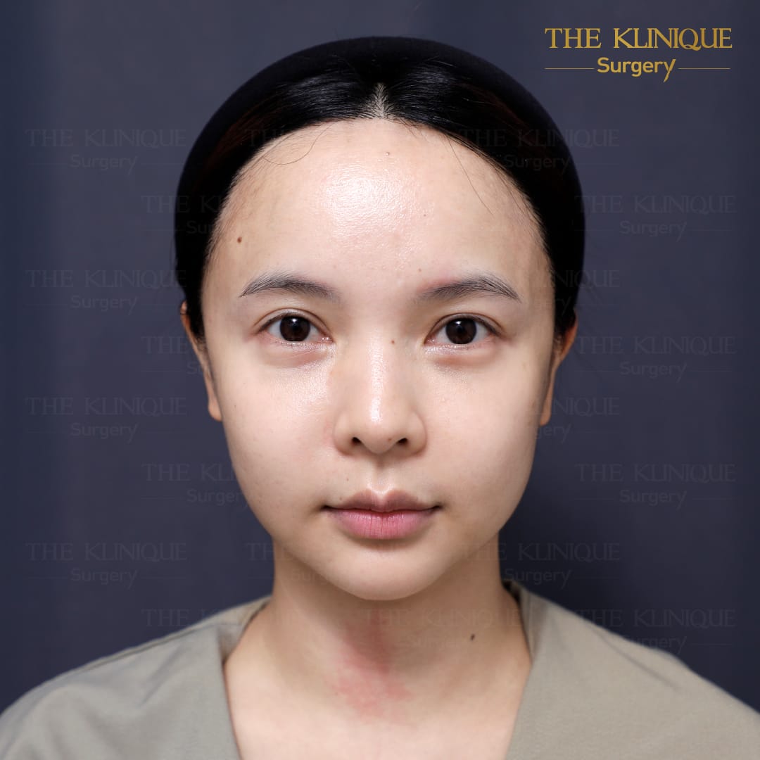 facelift review 10-year younger look before and after skin tightening procedure