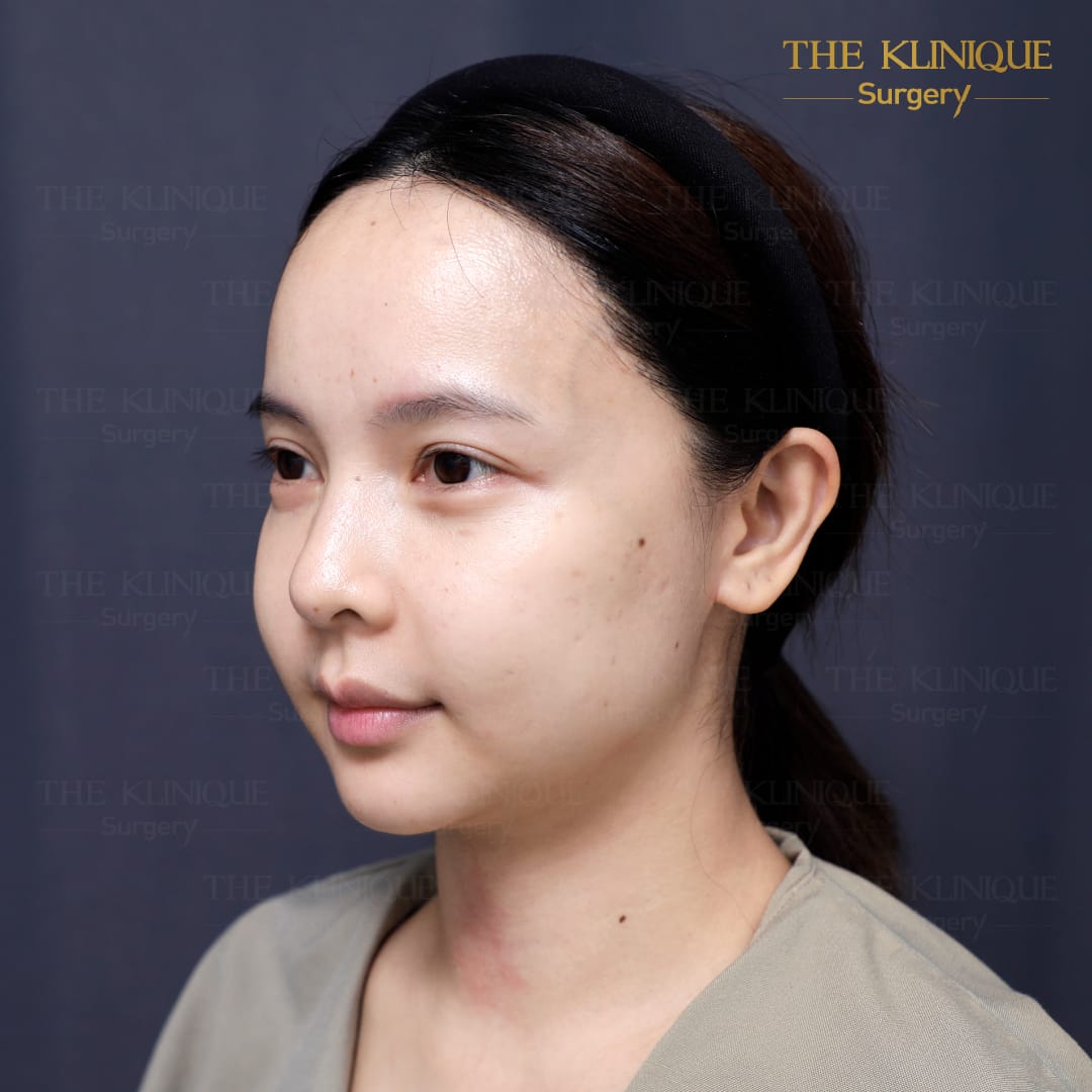 facelift review 10-year younger look before and after skin tightening procedure