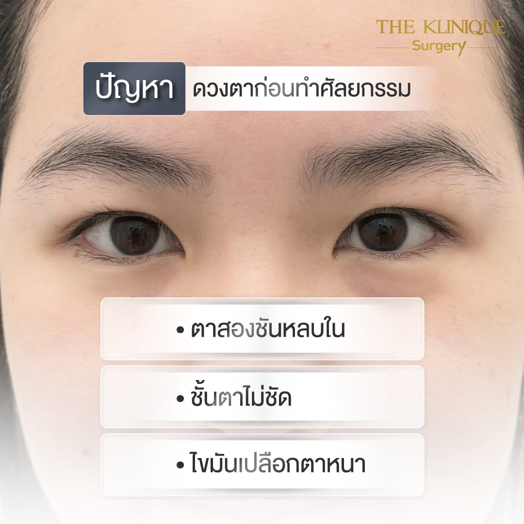 รีวิวทำตาสองชั้น แก้ไขปัญหาตาหลบใน