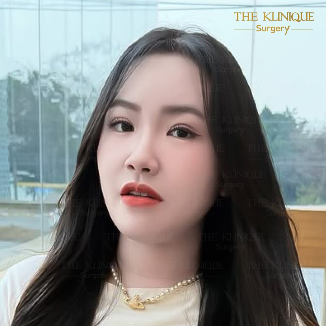 รีวิวทำตาสองชั้น แก้ไขปัญหาตาหลบใน