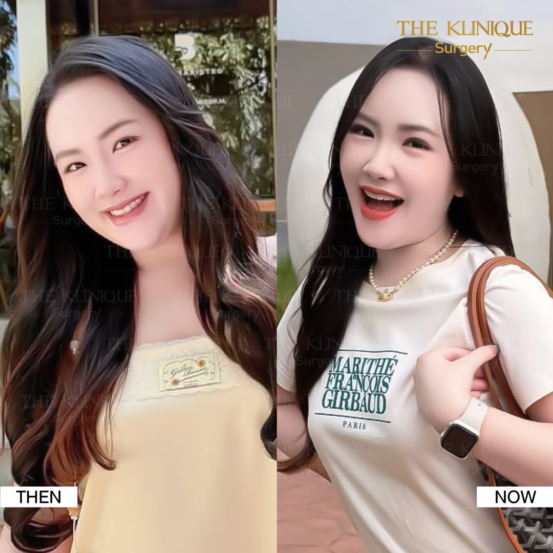 รีวิวทำตาสองชั้น แก้ไขปัญหาตาหลบใน