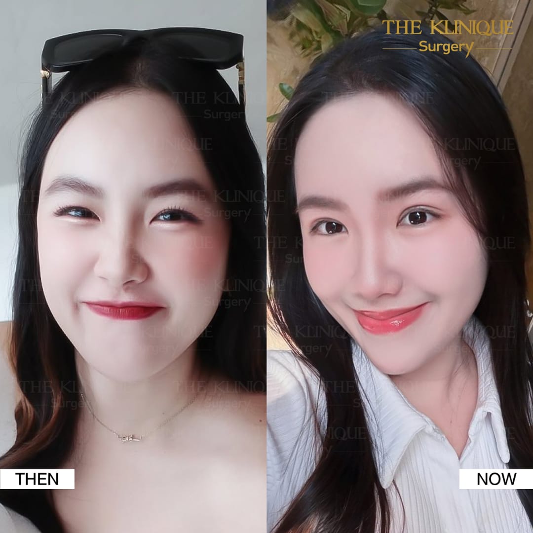 รีวิวทำตาสองชั้น แก้ไขปัญหาตาหลบใน