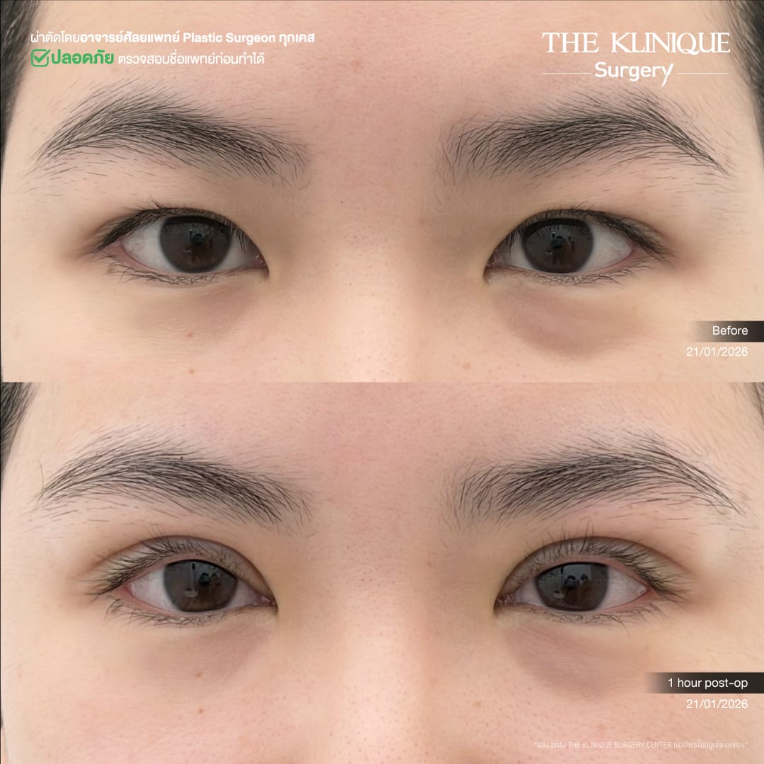 รีวิวทำตาสองชั้น แก้ไขปัญหาตาหลบใน