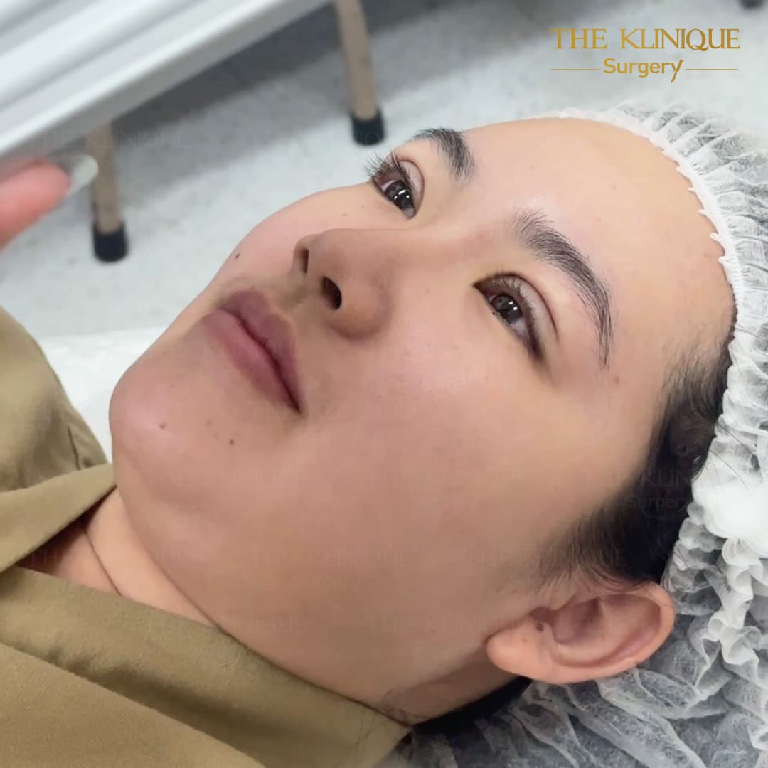 รีวิวทำตาสองชั้น แก้ไขปัญหาตาหลบใน