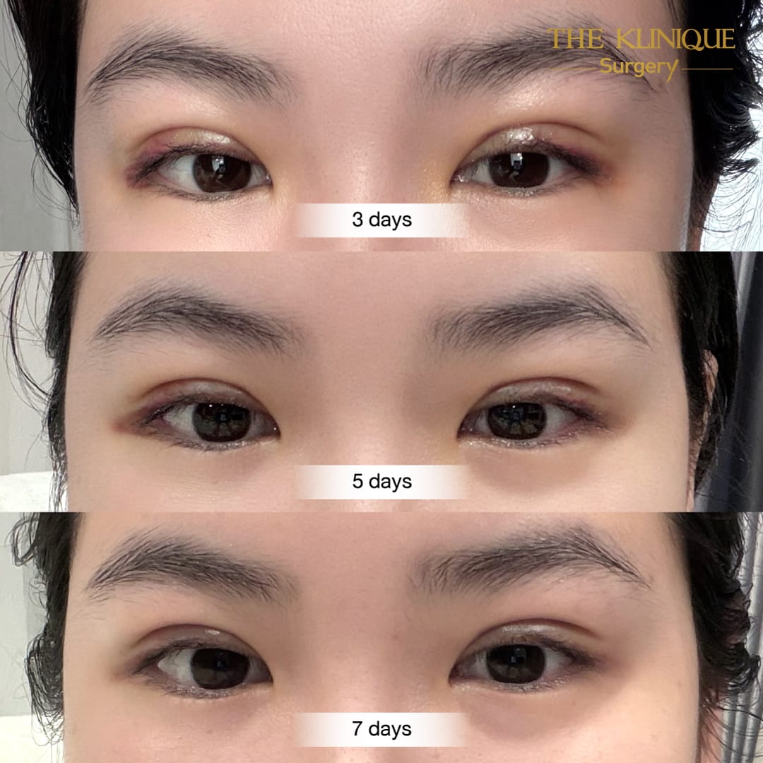 รีวิวทำตาสองชั้น แก้ไขปัญหาตาหลบใน