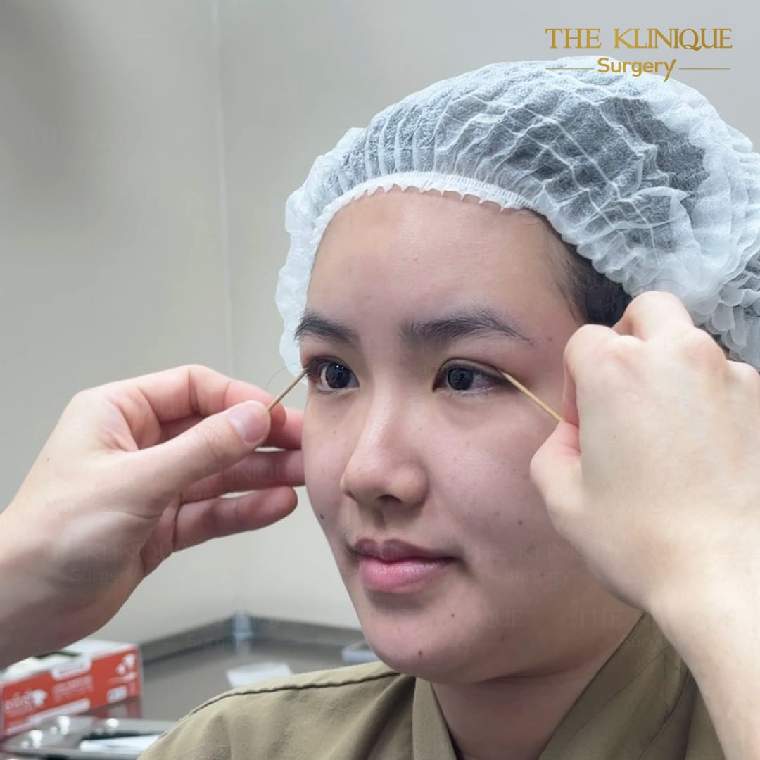 รีวิวทำตาสองชั้น แก้ไขปัญหาตาหลบใน