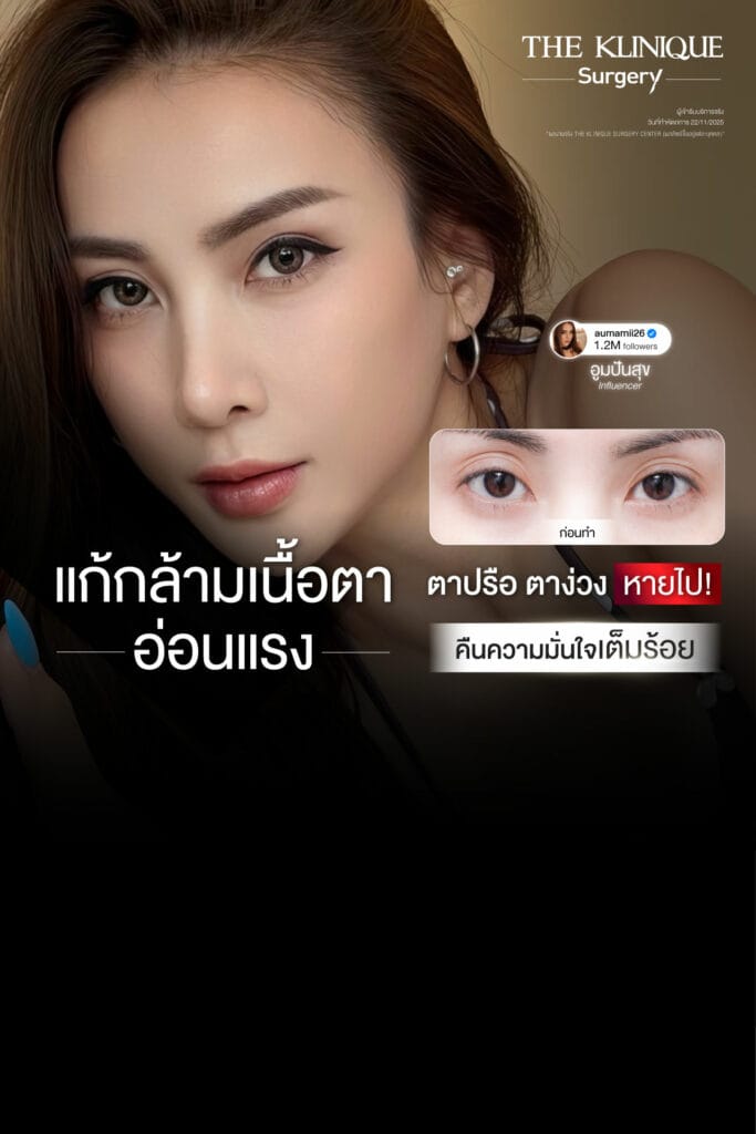 ศัลยกรรมตา, ศัลยกรรมตาสองชั้น, ศัลยกรรมตาสองชั้น ราคา, ศัลยกรรมตาที่ไหนดี, ศัลยกรรมตามีกี่แบบ, ตาสองชั้น, ตาสองชั้นหลบใน, คลินิกทำตา, ตาสองชั้นที่ไหนดี, ตาสองชั้นแบบกรีดสั้น กรีดยาว, กล้ามเนื้อตาอ่อนแรง, แก้ตา, แก้ตาสองชั้น, แก้หนังตาตก, แก้ชั้นตาใหญ่, แก้ตาไม่เท่ากัน, หนังตาตก, แก้หนังตาตก,Ophthalmologis,จักษุศัลยแพทย์,คลินิกทำตาสองชั้น ใจกลางสยามสแคว์ , แก้ตาอ่อนแรง ใจกลางสยาม,ตาง่วง, ตาปรือ, ทำตาสองชั้นที่ไหนดี, แพทย์ Oculoplastic, มัดกล้ามเนื้อตา, รีวิวแก้กล้ามเนื้อตาอ่อนแรง, แก้ไขกล้ามเนื้อตาอ่อนแรง