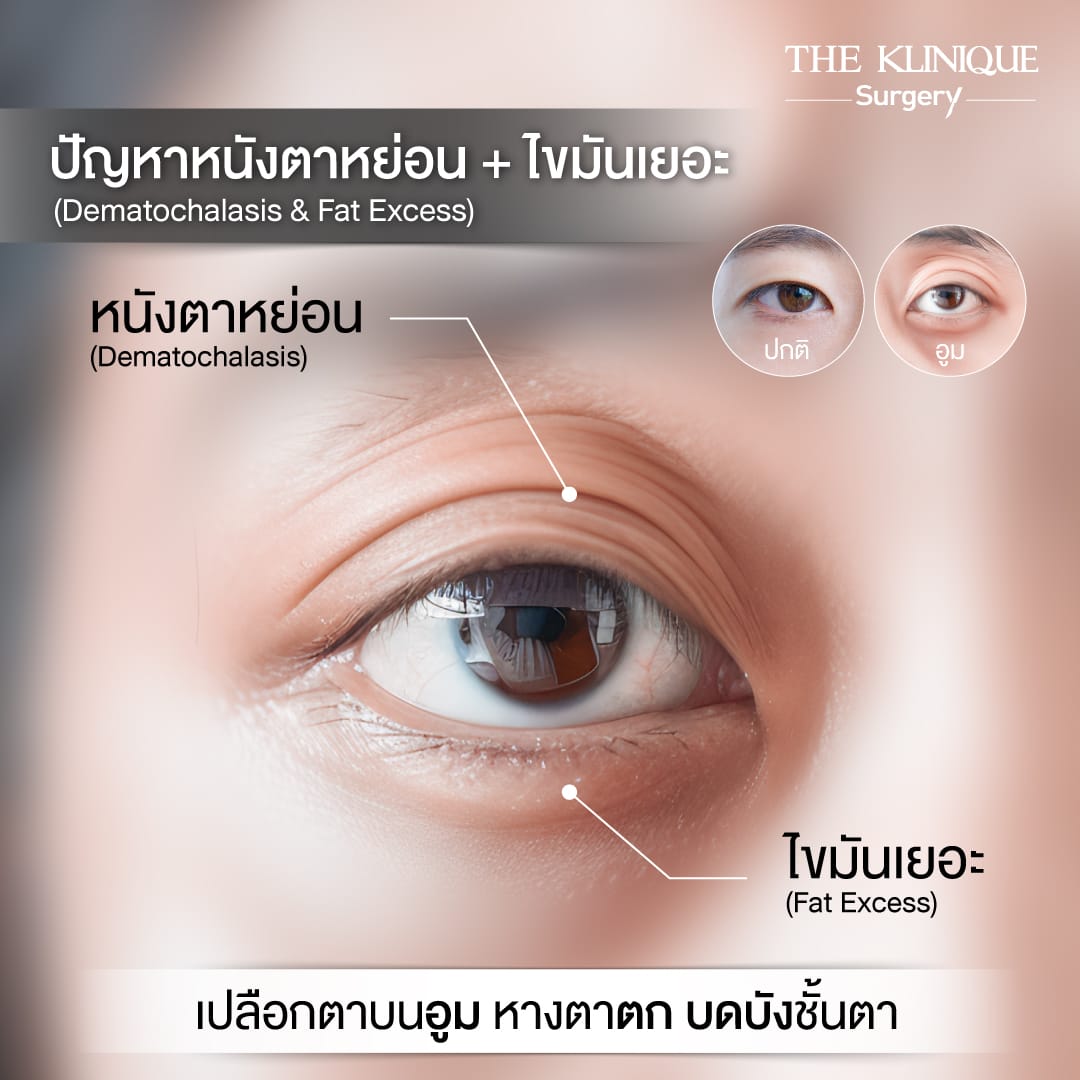 ศัลยกรรมตา, ศัลยกรรมตาสองชั้น, ศัลยกรรมตาสองชั้น ราคา, ศัลยกรรมตาที่ไหนดี, ศัลยกรรมตามีกี่แบบ, ตาสองชั้น, ตาสองชั้นหลบใน, คลินิกทำตา, ตาสองชั้นที่ไหนดี, ตาสองชั้นแบบกรีดสั้น กรีดยาว, กล้ามเนื้อตาอ่อนแรง, แก้ตา, แก้ตาสองชั้น, แก้หนังตาตก, แก้ชั้นตาใหญ่, แก้ตาไม่เท่ากัน, หนังตาตก, แก้หนังตาตก,Ophthalmologis,จักษุศัลยแพทย์,คลินิกทำตาสองชั้น ใจกลางสยามสแคว์ , แก้ตาอ่อนแรง ใจกลางสยาม,ตาง่วง, ตาปรือ, ทำตาสองชั้นที่ไหนดี, แพทย์ Oculoplastic, มัดกล้ามเนื้อตา, รีวิวแก้กล้ามเนื้อตาอ่อนแรง, แก้ไขกล้ามเนื้อตาอ่อนแรง