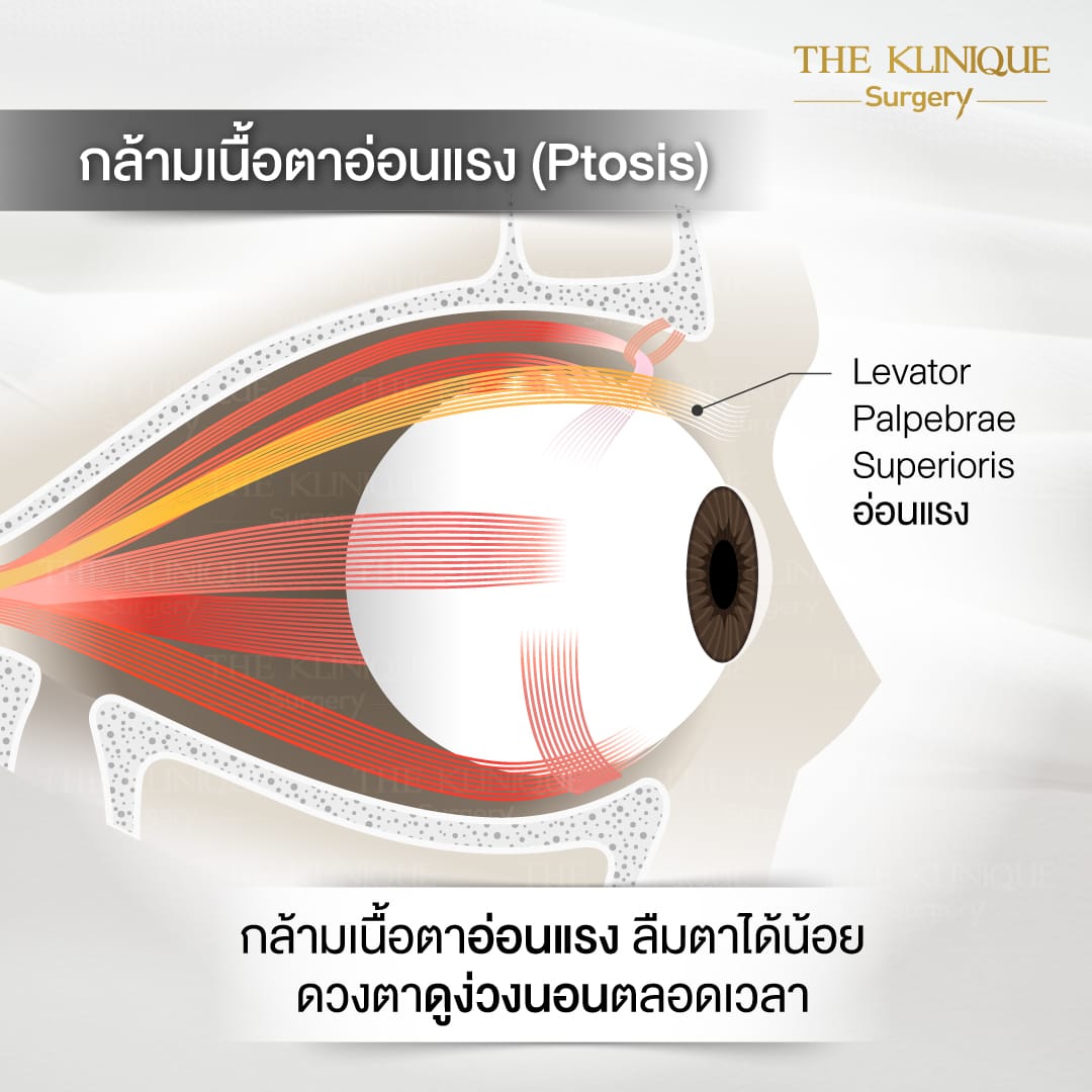 ศัลยกรรมตา, ศัลยกรรมตาสองชั้น, ศัลยกรรมตาสองชั้น ราคา, ศัลยกรรมตาที่ไหนดี, ศัลยกรรมตามีกี่แบบ, ตาสองชั้น, ตาสองชั้นหลบใน, คลินิกทำตา, ตาสองชั้นที่ไหนดี, ตาสองชั้นแบบกรีดสั้น กรีดยาว, กล้ามเนื้อตาอ่อนแรง, แก้ตา, แก้ตาสองชั้น, แก้หนังตาตก, แก้ชั้นตาใหญ่, แก้ตาไม่เท่ากัน, หนังตาตก, แก้หนังตาตก,Ophthalmologis,จักษุศัลยแพทย์,คลินิกทำตาสองชั้น ใจกลางสยามสแคว์ , แก้ตาอ่อนแรง ใจกลางสยาม,ตาง่วง, ตาปรือ, ทำตาสองชั้นที่ไหนดี, แพทย์ Oculoplastic, มัดกล้ามเนื้อตา, รีวิวแก้กล้ามเนื้อตาอ่อนแรง, แก้ไขกล้ามเนื้อตาอ่อนแรง