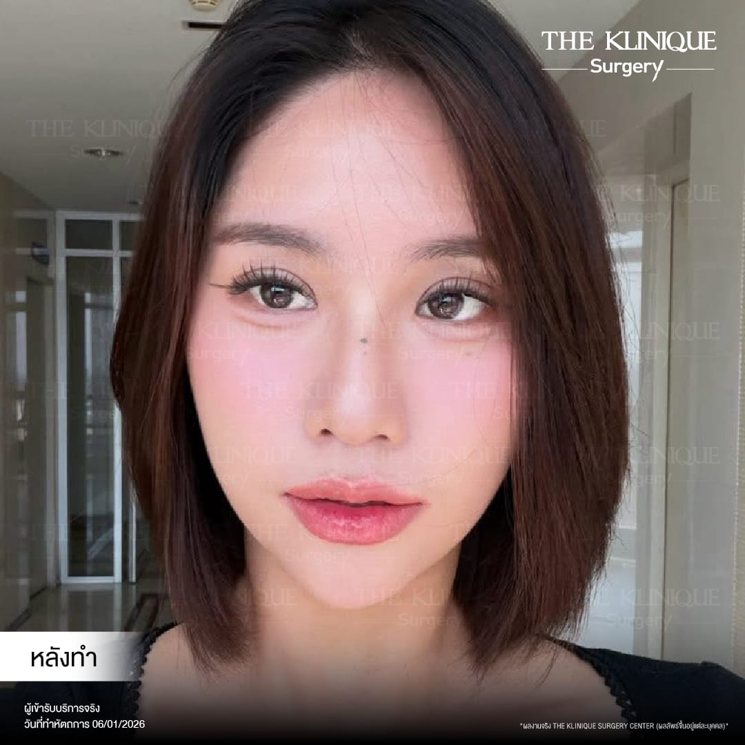 Expert Ophthalmologist Dr. Son analyzing eyelid muscle function for revision surgery