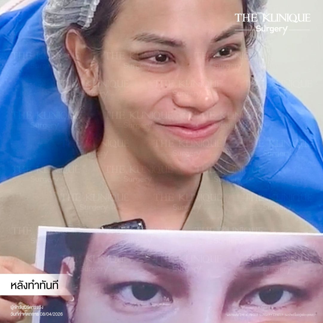 Expert Ophthalmologist Dr. Son analyzing eyelid muscle function for revision surgery