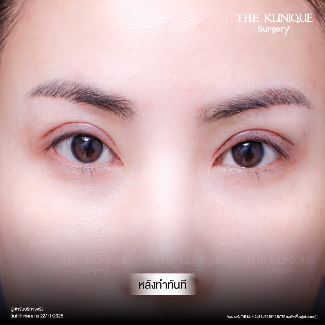 Expert Ophthalmologist Dr. Son analyzing eyelid muscle function for revision surgery