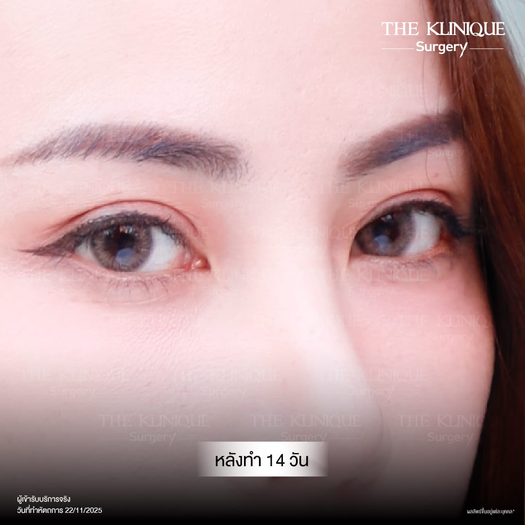 Expert Ophthalmologist Dr. Son analyzing eyelid muscle function for revision surgery